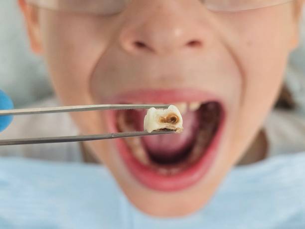 Best Emergency Tooth Extraction in Tipton, CA